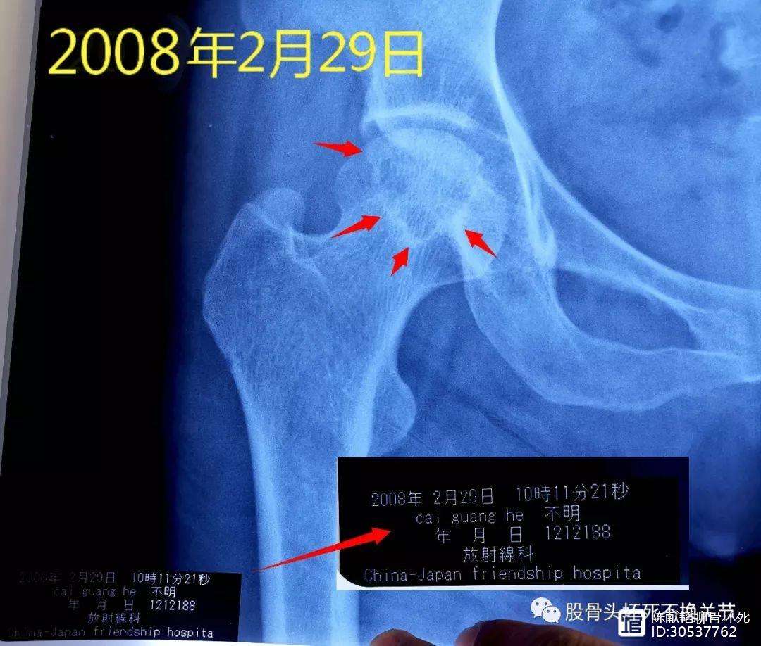 赣州人工骨头医保报销多少(人工骨头医保报销多少比例)